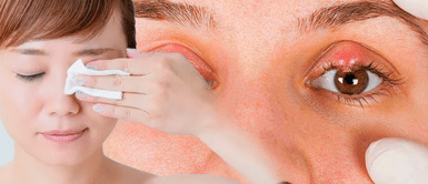 Orzuelo causas y tratamiento para eliminarlo rápido Orzuelo: ¿Por qué ocurre y cómo evitarlo? Conoce las razones detrás de su aparición y cómo protegerte