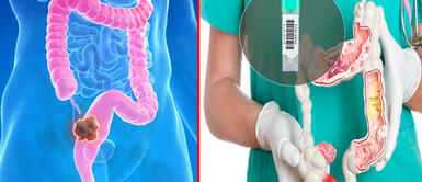 El tamizaje del cáncer de colon y recto se recomienda para personas entre 50 y 75 años Conoce más sobre innovador test para detección de cáncer de colon con alta efectividad