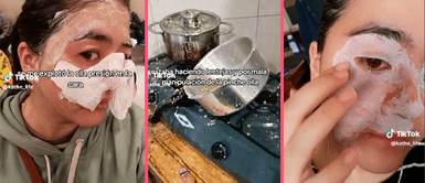 Joven sufre accidente con olla a presión: "Me explotó en la cara haciendo lentejas" Joven sufre accidente con olla a presión: "Me explotó en la cara haciendo lentejas"