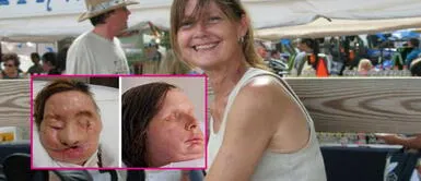 Charla Nash: el antes y después de su reconstrucción de rostro La horrible tragedia de Charla Nash: su propia mascota le despedazó el rostro dejándola marcada de por vida