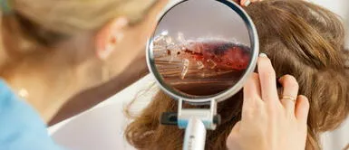 Los piojos en el sueño de tu hija podrían estar enviándote un mensaje importante ¿Qué significa soñar con piojos en la cabeza de mi hija?