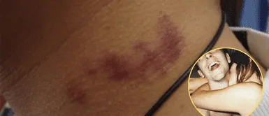 Conoce qué es un chupetón. ¿Por qué es malo que te dejen chupetones? Especialistas responden