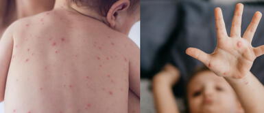 Esta enfermedad todos la han padecido cuando eran niños. Varicela: ¿Qué es la culebrilla y cómo se puede prevenir su aparición?