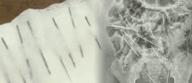 ¡Casi no la cuenta! Menor de dos años se traga ocho agujas y médicos le salvan la vida ¡Casi no la cuenta! Menor de dos años se traga ocho agujas y médicos le salvan la vida