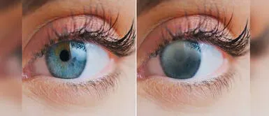 Cataratas en los ojos: 80% de personas que padecen esta patología pueden encontrar solución con cirugía Cataratas en los ojos: 80% de personas que padecen esta patología pueden encontrar solución con cirugía