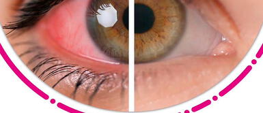 El lado izquierdo del ojo está con la enfermedad, mientras que la zona derecha está sana. Uveítis es la tercera causa de ceguera en el mundo: ¿Cuáles son sus síntomas?