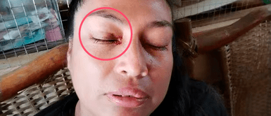 Reportan extraño caso de mujer que suda SANGRE por estrés en Loreto Reportan extraño caso de mujer que suda SANGRE por estrés en Loreto