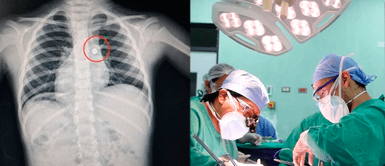 Doctores salvan la vida a niño de 4 años que aspiró una pila de reloj en Trujillo ¡HÉROES SIN CAPA! Doctores salvan la vida a niño de 4 años que aspiró una pila de reloj en Trujillo