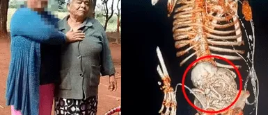 Mujer de 81 años MURIÓ tras extirpar el FETO CALCIFICADO que llevó durante 56 años: ¿Cómo es posible? Mujer de 81 años MURIÓ tras extirpar el FETO CALCIFICADO que llevó durante 56 años: ¿Cómo es posible?