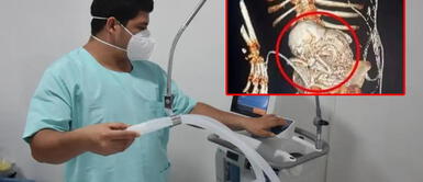 Mujer pierde la vida tras extirparse "feto calcificado" desde hace más de 30 años Mujer pierde la vida tras extirparse "feto calcificado" desde hace más de 30 años