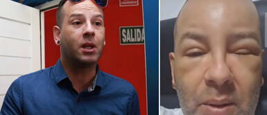 Ricky Trevitazo sufre terrible efecto secundario al someterse a trasplante capilar Ricky Trevitazo sufre terrible efecto secundario al someterse a trasplante capilar