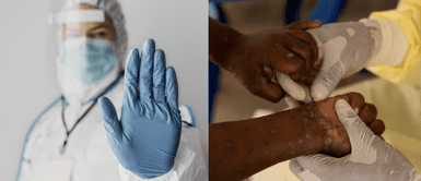 OMS confirma nueva emergencia sanitaria por viruela del mono en todo el planeta ¿Otra Pandemia? OMS confirma nueva emergencia sanitaria por viruela del mono en todo el planeta