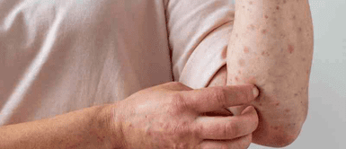 Conoce todos los síntomas de la viruela del mono. ¡ALERTA en Perú! Gobierno revela SÍNTOMAS CLAVES y vías de contagio de la VIRUELA del MONO