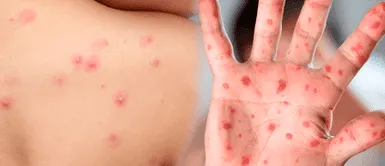 Minsa emite alerta epidemiológica por nueva variante de viruela del mono ¿CUARENTENA POR VIRUELA DEL MONO? Minsa emite alerta epidemiológica por nueva variante
