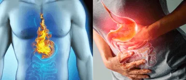 La gastritis, un fuego estomacal. En el comer está el vivir: Cómo superar la gastritis