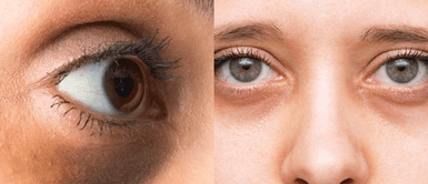 La falta de sueño es uno de los más comunes, ya que la fatiga hace que la piel se vuelva más pálida, revelando las venas oscuras debajo. Ojeras: Causas, prevención y consejos para lucir una mirada fresca