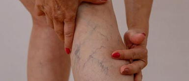 El doctor indica que la principal causa de esta afección es genética. ¿Por qué aparecen las várices y cómo prevenirlas?