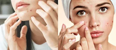 Brote de acné. ¿Tienes espinillas? Así puedes acabar con el acné con ayuda de la clara de huevo