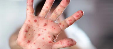 ¿Nueva Pandemia? Minsa lanza alerta epidemiológica tras rebrote de sarampión Minsa lanza alerta epidemiológica tras rebrote de sarampión