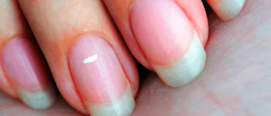 Uñas con rayas: qué significan y lo que expresan de la persona que las tiene ¿Tienes rayas en las uñas? Descubre el oscuro motivo que hay detrás que involucra tu salud