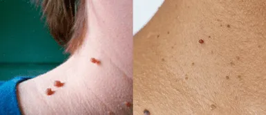 Lunares de carne. ¡Cuidado! Los peligros de sacarse lunares de carne: Expertos alertan sobre riesgos críticos
