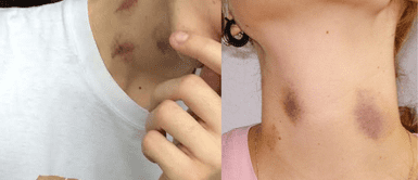 Manera rápida de borrar los chupetones. ¿Cómo eliminar los ‘chupetones’? De manera fácil y segura