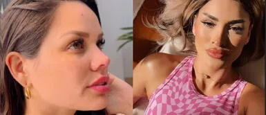 Ácido hialurónico, todo los que debes saber si has pensado en aumentar tus labios Ácido hialurónico: El secreto de las influencers para unos labios de infarto