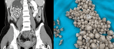 Médicos extraen 300 cálculos renales de una mujer. ¡Escalofriante operación! Médicos extraen 300 cálculos renales de una joven de 20 años