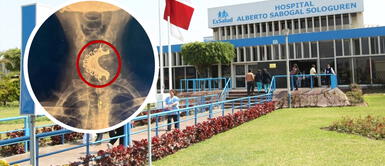 Anciano se tragó su dentadura postiza y estuvo dentro de su cuerpo por 4 días Anciano se tragó su dentadura postiza y estuvo dentro de su cuerpo por 4 días