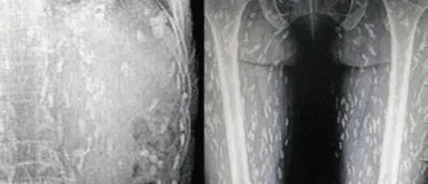 cuerpo de un hombre termina infestado de gusanos por consumir comida contaminada El cuerpo de un hombre se convierte en un campo de gusanos tras consumir comida contaminada