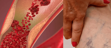 Mala circulación. Esta es la vitamina que ayuda a combatir la mala circulación de la sangre