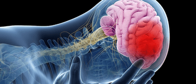 Accidentes cerebrovasculares. Este es el tipo de sangre con mayor riesgo de tener accidentes cerebrovasculares, según un estudio
