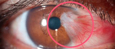 La milagrosa vitamina preferida por los oculistas para prevenir cataratas y el glaucoma inundaciones La vitamina milagrosa que te salva de las cataratas que todos los oculistas prefieren