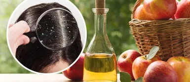 Remedio casero: Combatir la caspa ¡Adiós, caspa! El vinagre se convierte en el héroe inesperado para tu cuero cabelludo