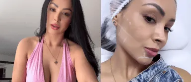 Pamela Franco se somete a retoquito Pamela Franco se somete a 'retoquitos' en el rostro y muestra los resultados