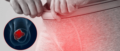 Cáncer de pene. Aumentan casos de cáncer de pene en el mundo: Especialistas revelan la razón