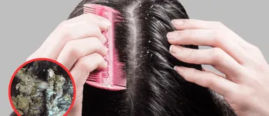 Caspa en el cabello. El trucazo infalible para eliminar la caspa con un ingrediente casero