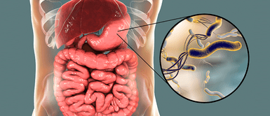 Cáncer de estomago. Este alimento destruye la bacteria del Helicobacter pylori desde el primer día