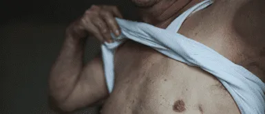 Cáncer de mama. Cáncer de mama en varones: una enfermedad silenciosa que muchos desconocen