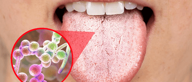 Sustancia blanca en la lengua. ¿Lengua blanca? Descubre qué significa y por qué podría ser una señal de alerta para tu salud
