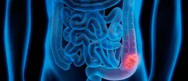 Cáncer de colón. Doctor de Harvard revela el alimento clave que previene el cáncer de colon