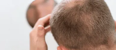 Calvicie. ¿El secreto para combatir la calvicie? Esta hoja natural está causando furor y muchos aseguran que funciona