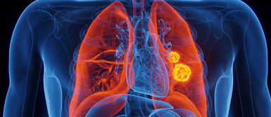 Cáncer de pulmón. Estos 3 signos podrían indicar cáncer de pulmón y muchos los ignoran