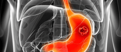 Cáncer gástrico. Científicos Alertan: si tienes este tipo de sangre, tu riesgo de cáncer gástrico es mayor