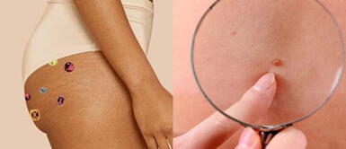 Ingredientes caseros para deshacerte del acné de los glúteos Adiós acné en glúteos: 5 ingredientes caseros que te salvarán la piel