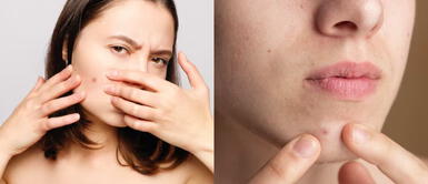 Estos son los mejores productos para secar granos y espinillas que SÍ funcionan Estos son los mejores productos para secar granos y espinillas que SÍ funcionan