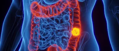 Cáncer de intestino. Cuatro signos del cáncer de intestino que pueden pasar desapercibidos