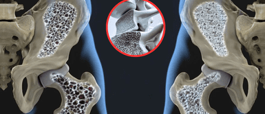 Hábitos para evitar la osteoporosis. El hábito olvidado que fortalece los huesos y previene la osteoporosis