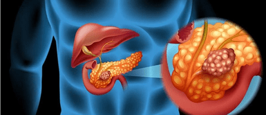 Cáncer de páncreas. Descubren la proteína "asesina" que impulsa el cáncer de páncreas