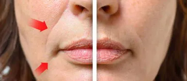 Sábila para líneas de expresión en la boca: cómo aplicarla y aprovecharla Sábila para líneas de expresión en la boca: cómo aplicarla y aprovecharla